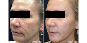 Before-and-after laser treatment image from the source site