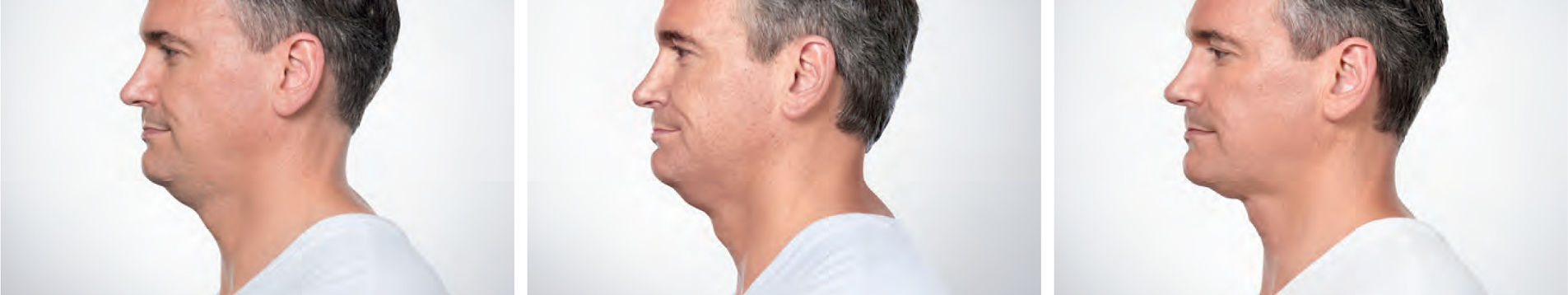 Kybella® Services