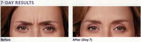 Close-up before-and-after Botox example from the source site
