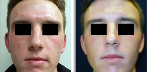 Before-and-after laser treatment image from the source site