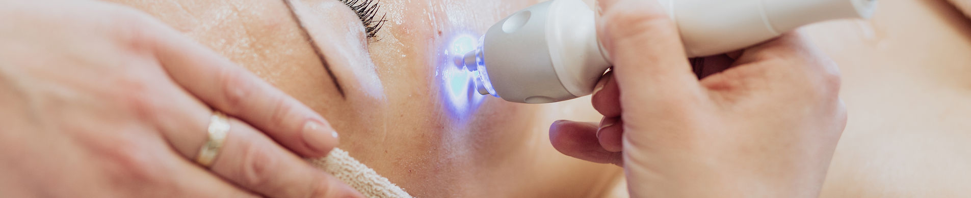 Laser Treatments