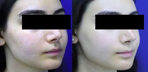Before-and-after laser treatment image from the source site