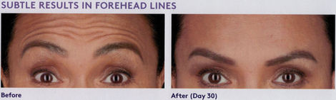 Before-and-after Botox example from the source site
