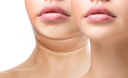 Kybella before-and-after image from the source site